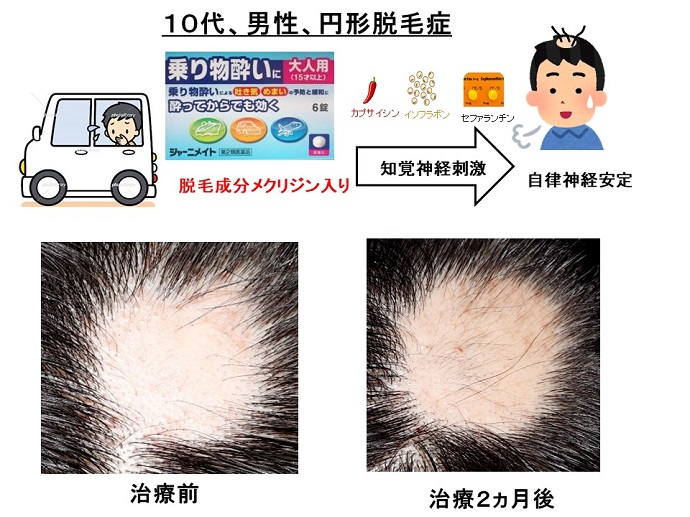 円形脱毛症　名医